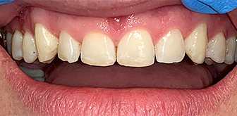 Healthy beautiful smile after dental treatment